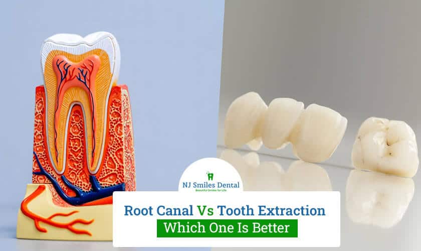 Root Canal vs Tooth Extraction