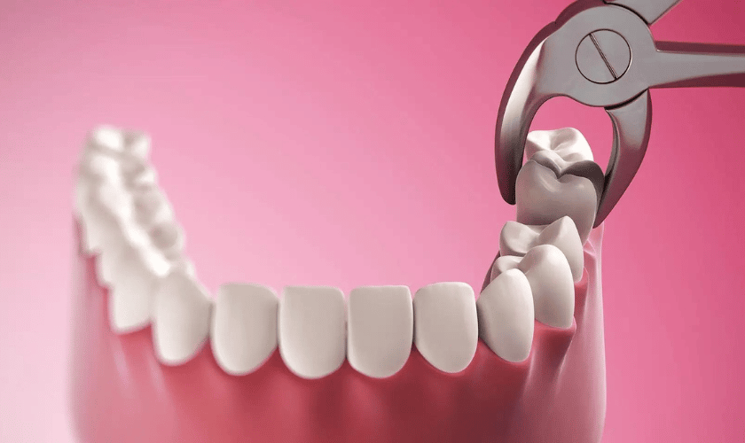 How Do You Prepare Yourself For A Tooth Extraction