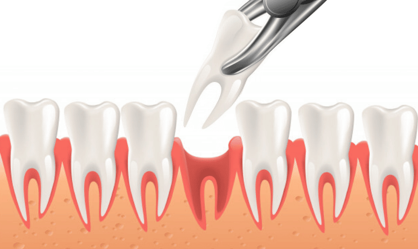 What Should You Avoid After Tooth Extraction?