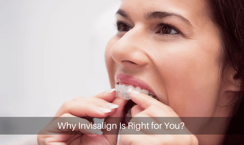 Why Invisalign Is Right for You?